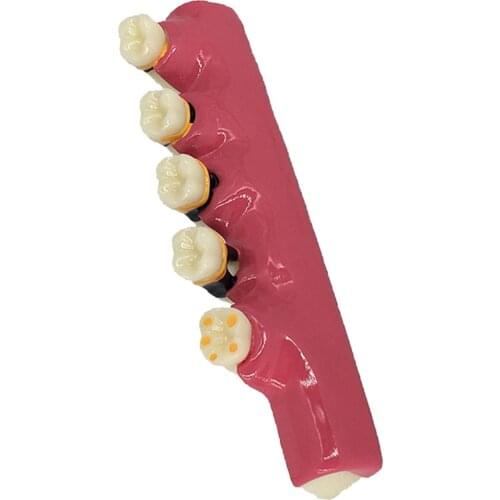 1Pc Caries Developing Illustration Teeth Disease Tooth Model
