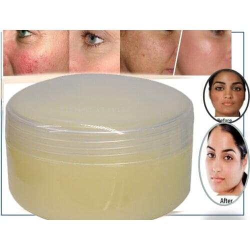 Remove freckle speckle peels dark spot face facial skin whitening cream