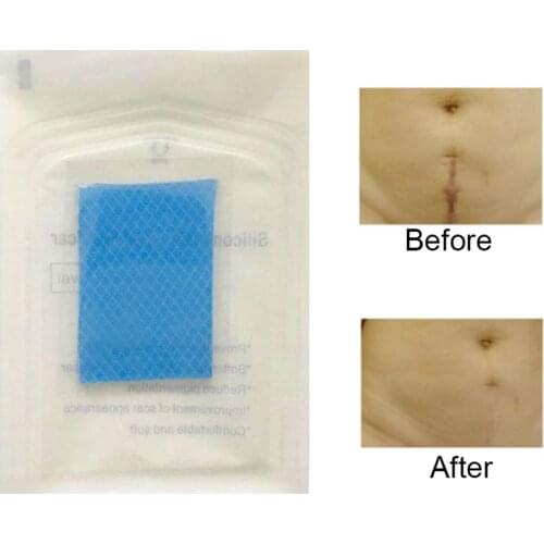 Silicone Caesarean Surgery Scar Removal Sheet Repairing Acne Trauma Burn Patch hot sale
