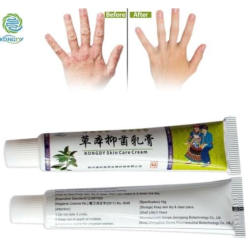 KONGDY 3 lots Chinese Nature Herbs 15g Skin Care Cream Body Dermatitis Balm for Psoriasis Eczema Ointment