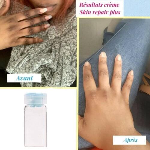 Corrective skin-lightening cream for hyperpigmentation for hands, feet
