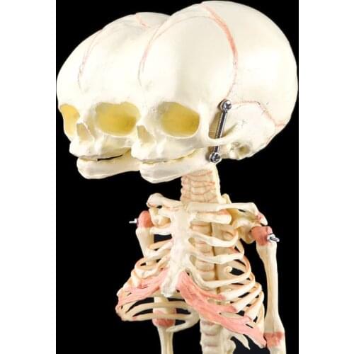Human Baby Deformed Head Skull Research Model Skeleton Anatomical Brain Anatomy