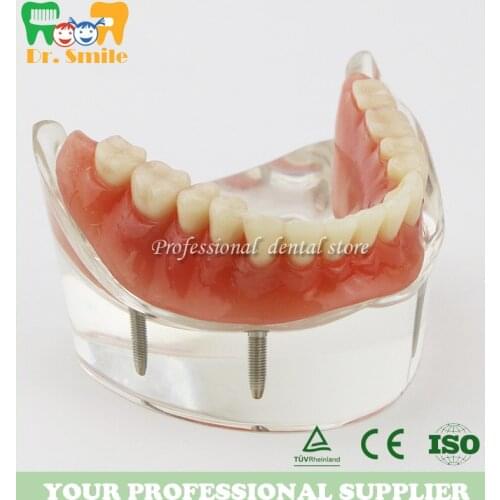 Dental Teeth Study Model Overdenture Inferior 4 Implant Demo Model