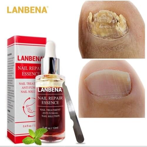 Nail Fungal Treatment Feet Care Essence Nail Foot Whitening Toe Nail Fungus Removal Gel Anti Infection Paronychia Onychomycosis