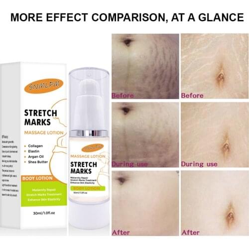 Remove Pregnancy Scars Acne Cream Stretch Marks Treatment Maternity Repair Scar Slack Line Abdomen Stretch Marks Cream