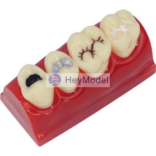 HeyModel Teeth Pit and fissure model Dental dentition model