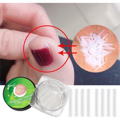Silicone Ingrown Toenail Correction Tool Invisible Ingrown Toe Nail Treatment Elastic Straightening Clip Brace Pedicure Tool