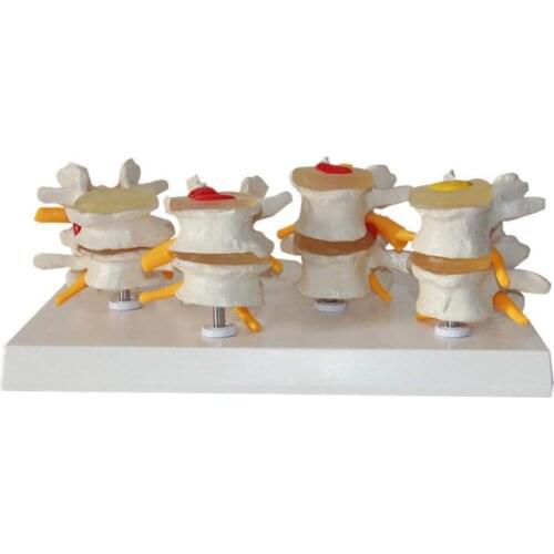 Medical Human anatomy skeleton Spine 4-stages lumbar vertebrae model Human Lumbar Lesion Spinal Statue Display Model