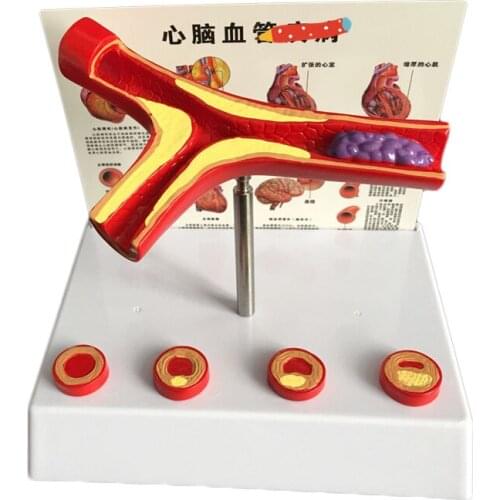 Simulated blood vessel model active blood vessel occlusion thrombosis lesion specimens 4-stage arteriosclerosis