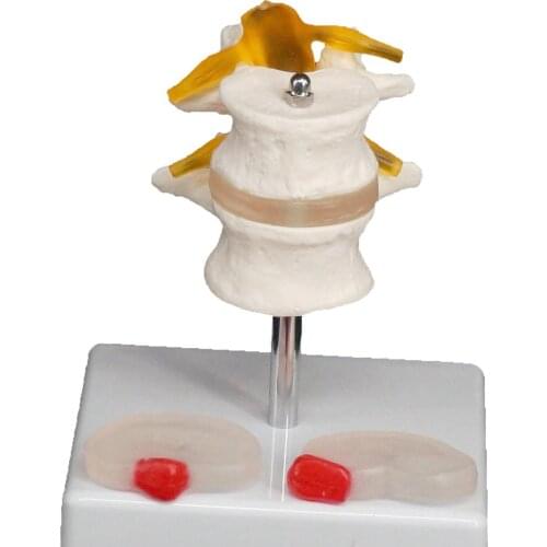 Human Two Lumbar Lesions Intervertebral Disc Skeleton Spine Model Medical Teaching Training Aid