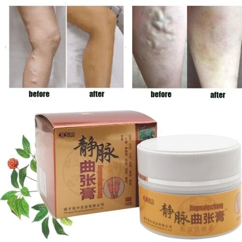30 grams of varicose vein cream pure natural plant extract is good for varicose vein vasculitis health cream ointment
