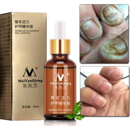 2020 Fungal Nail Treatment Feet Care Essence Nail and Foot Whitening Toe Nail Fungus Removal Nail Gel