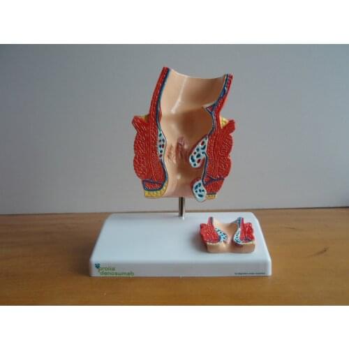Human Rectal Diseased Medical Anatomical Model