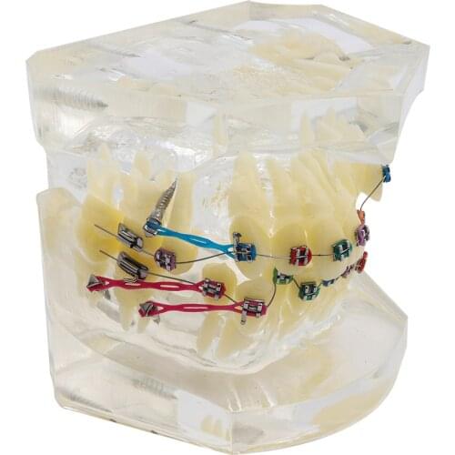 Dental Model with Brackets Buccal Tubes Ligature Wire Orthodontic Treatment Transparent Standard Teeth