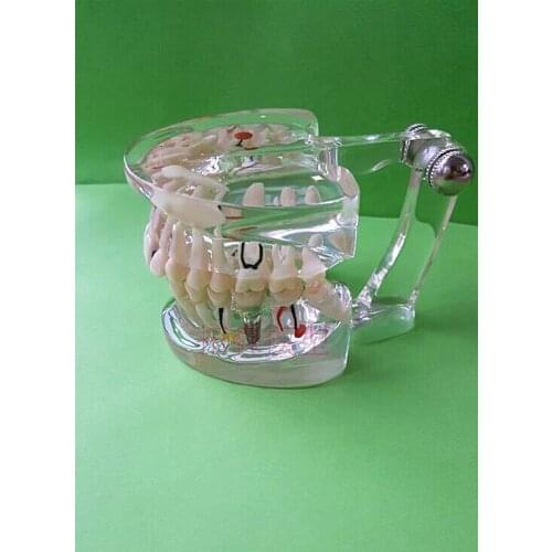 Dental Materials pathology Teeth model Removable free shipping