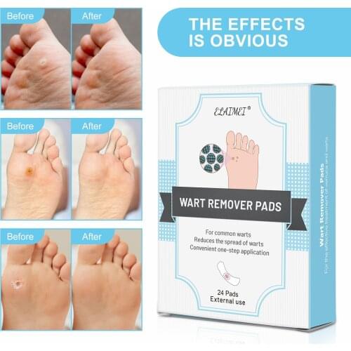 Corn Remover Pads for Foot Care Wart Remover Foot Corn Remover Corn & Callus Remover Cushions Corn Plaster Hole Corn Treatment