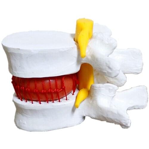 Lumbar vertebra model intervertebral disc Lumbar spine protrusion skeleton spine anatomy medical teaching