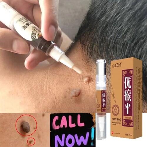 Skin Tag Remover Against Mole & Genital Wart fast RemovWithin al Anti Foot Corn Removal Warts Papillomas Rapidly removes moles