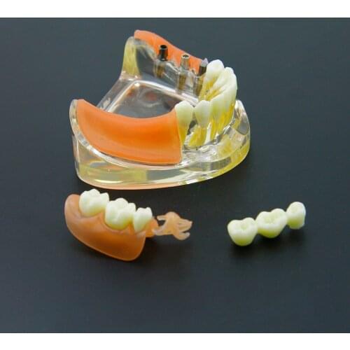 Dental Implant Restoration Teeth Model Removable Bridge Denture Demo #6006