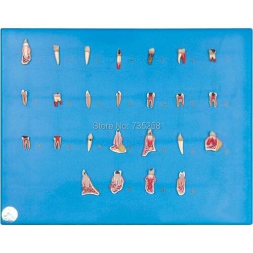 Dental Diseases Model,25 Kinds of Dental Pathology Model
