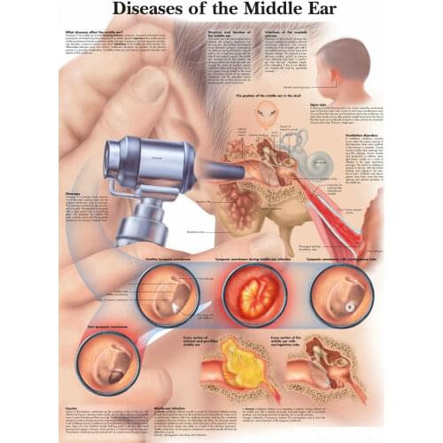 Diseases of the Middle Ear Picture Art print Silk poster Home Wall Decor