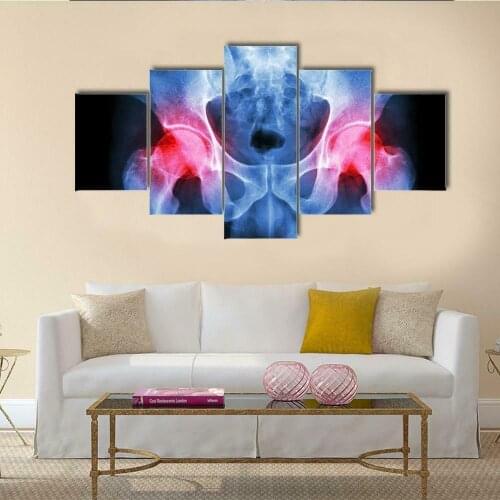 Humans Pelvis Arthritis X-ray 5 Panel Canvas Picture Print Wall Art Canvas Painting Wall Decor for Living Room Poster No Framed