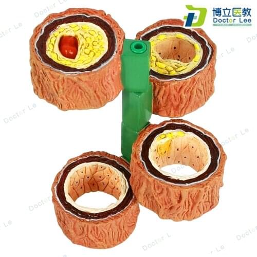 Medical Educational Equipment and Supplies 4-Stage Cross Section Human Artery Anatomical Vascular Occlusion Model