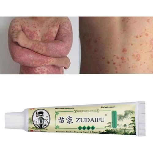 NERJING Zudaifu Psoriasis Cream Skin Care Cream Psoriasis Skin Cream Dermatitis Eczematoid Eczema Ointment Treatment 15g #E