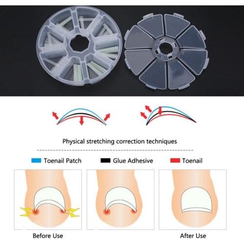 PRO. 120pcs Ingrown Toenail Straightening Clip Sticker Brace Toenails Thick Paronychia Acronyx Correction Patch 4x26mm