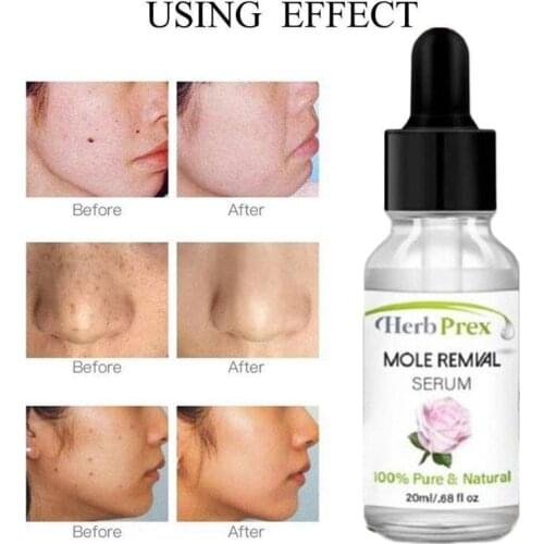 No Trace Mole Removal Cream Essential Oil 20ml Organic Tags Solutions Serum Skin Tag Mole Freckle Spot Fast Remover Skin Care