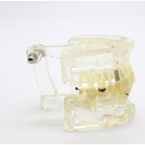 Dental Supplies Implant Disease Tooth Pathological Extrusion Missing Teeth Model 4001 for Teaching