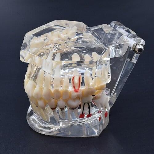 Dental Accessories High Quality Teeth Model Dental Implant Disease Teaching Study