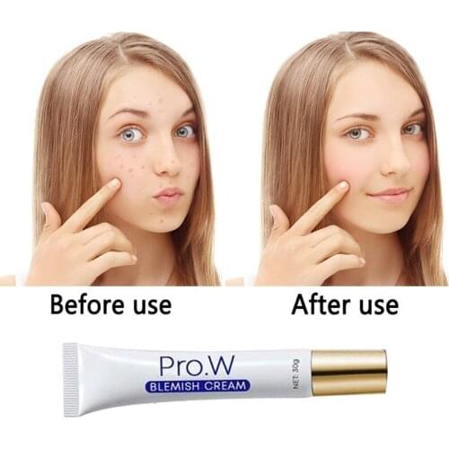 Pro.w Face Acne Treatment and Spot-Removing Cream Blackhead Removal Water-Oil Balance Shrink Pores Blemish Cream Skin Care