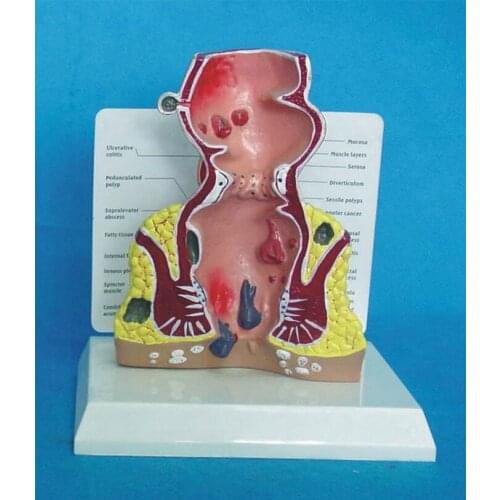 Rectum Model of The Human Anatomy Pathological Disease Rectal Ulcer Acne Pathological Model Use for Medical Anatomical Model