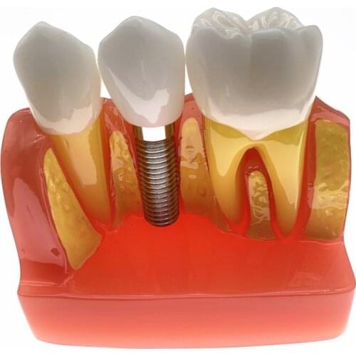 Dental Teach Implant Analysis Crown Bridge Removable Model Dental Demonstration Teeth Model 2017