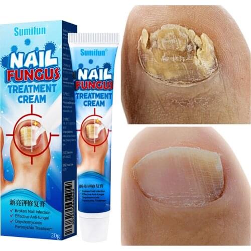 Nail Fungal Repair Cream Herbal Nail Treatment Cream Promote New Nails Growth Fingernails Toenails Cream Repair Essence Care
