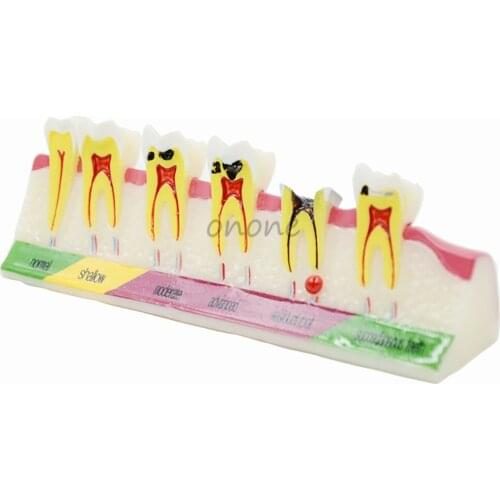 1pcs Dental Caries Developing illusteation Tooth Model Demonstration Teach Patient
