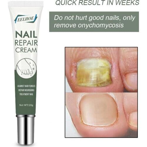Minimalistic 20g/Bottle Versatile Nail Fungus Repair Ointment Skin Friendly Nail Repair Ointment Effective for Home
