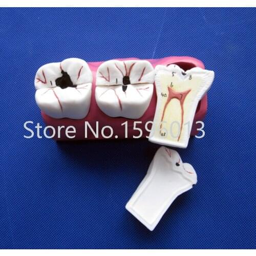 Dissected Model of Dental Caries,Caries decomposition model