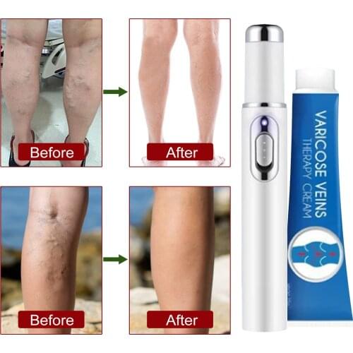Blue Light Therapy Varicose Veins Pen Spider Varicose Veins Cream Varicose Veins Ointment Soft Scar Removal HOT Cream