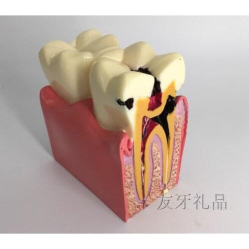 Enlarged dental model 6X teeth model dental caries contrast teaching model