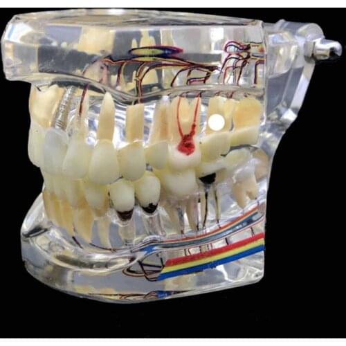 Dental Restoration Teeth Model with Teeth Nerve Detachable Teeth Disease Teaching Model Transparent Implant Disease Teeth Model