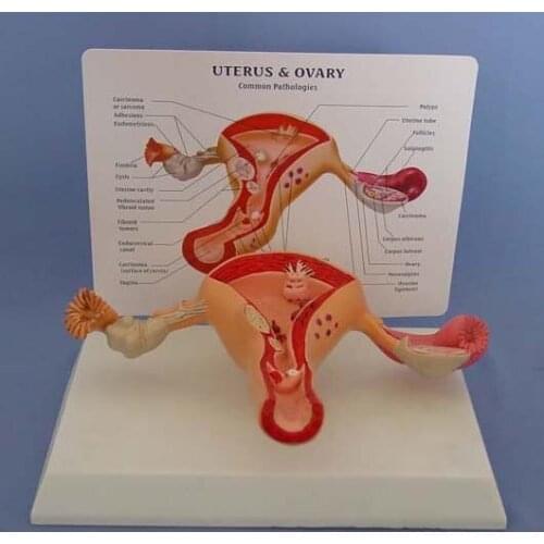 Uterus & Ovary Female genital uterus model vaginal ovary pathological changes obstetric structure teaching aids
