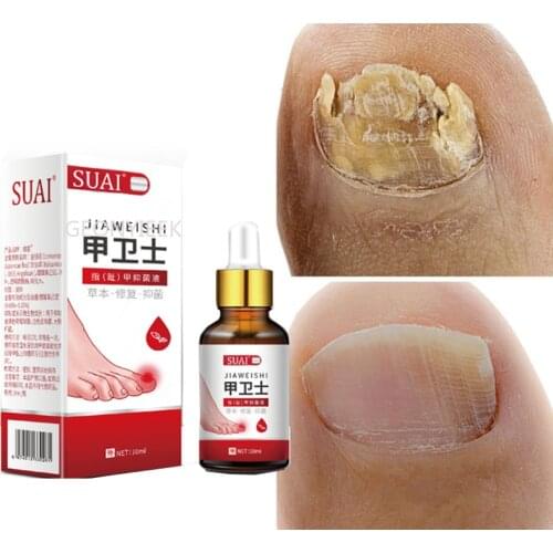 Nail Fungal Treatment Feet Care Essence Nail Foot Whitening Toe Nail Fungus Removal Gel Anti Infection Paronychia Onychomycosis