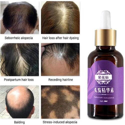 Lucky-Beauty 2021 Ginger Fast Hair Growth Serum Essential Oil Anti Preventing Hair Lose Liquid Damaged Hair Repair Growing