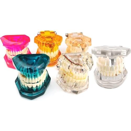 Dental Implant Disease Teeth Model with Restoration Bridge Tooth Dentist for Science Dental Disease Teaching Study Model