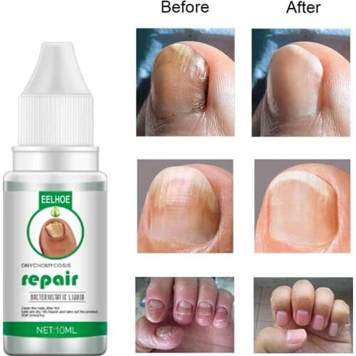 New Fungal Nail Repair Essences Serum Toe Nail Fungus Treatments Nails Gel Anti Infections Paronychia Onychomycosis Nails Care