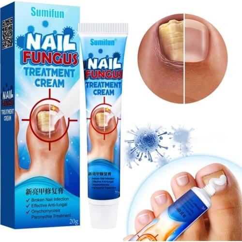 1Pcs Nail Fungus Removal Cream Onychomycosis Fungal Nail Treatment Paronychia Anti Infection Feet Toe Fungal Nail Care Ointment