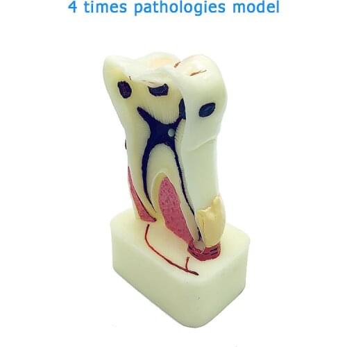 4 Times Pathologies Model Dental Teeth Model Dentist Studying and Researching Dentistry Product