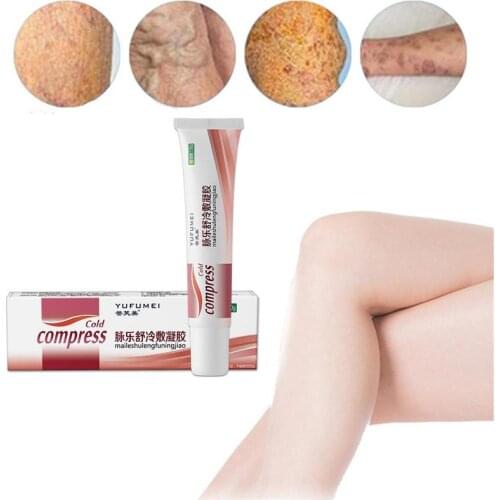 Pain Relief Varicose Veins Cream Herbal Analgesic Plaster Angiitis Remedy Leg Ointment Varicosity Phlebitis Spider Y1X9
